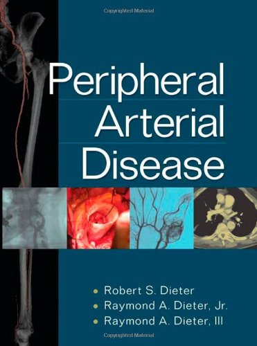 Peripheral Arterial Disease