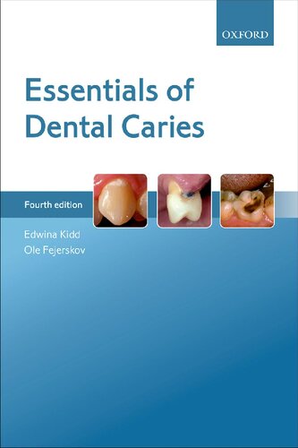 Essentials of dental caries