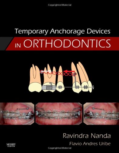 Temporary Anchorage Devices in Orthodontics