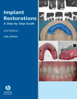 Implant restorations : a step-by-step guide