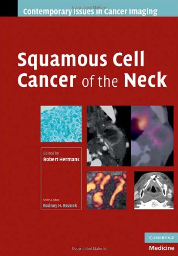 Squamous Cell Cancer of the Neck