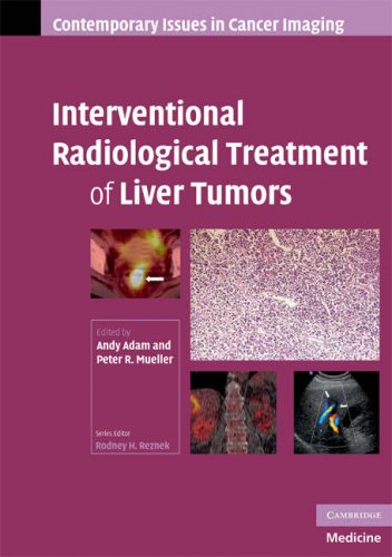 Interventional Radiological Treatment of Liver Tumors