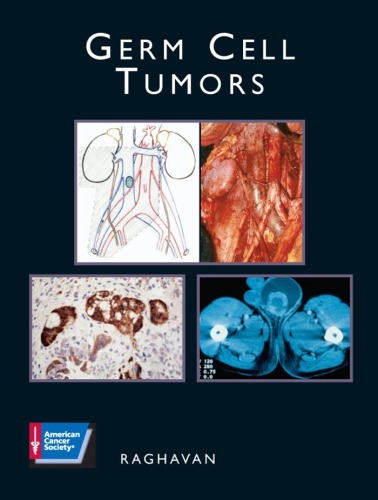 Germ cell tumors
