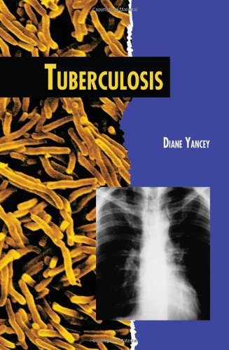 Tuberculosis, 2nd Edition