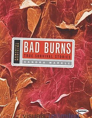 Bad Burns