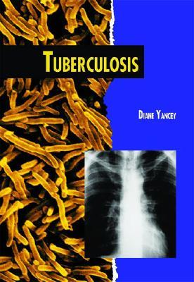 Tuberculosis