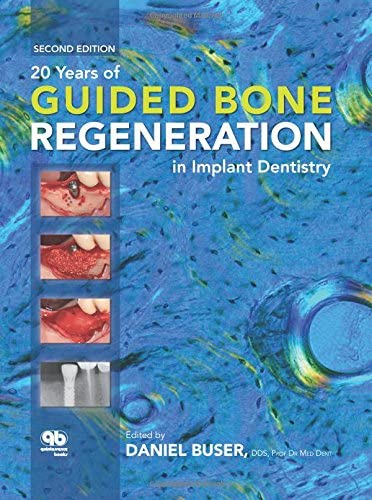 20 Years of Guided Bone Regeneration in Implant Denistry