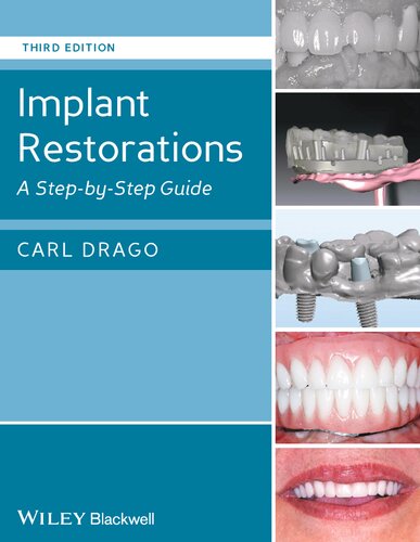 Implant Restorations