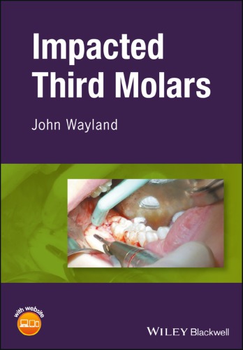 Impacted third molars