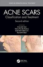 Acne Scars