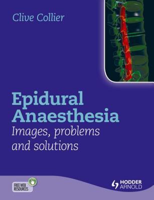 Epidural Anaesthesia