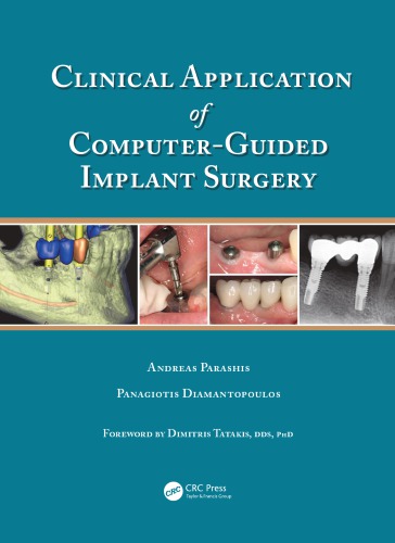 Clinical application of computer-guided implant surgery