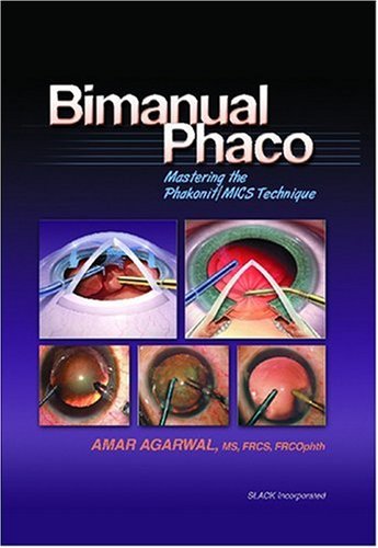 Bimanual Phaco: Mastering the Phakonit/MICS Technique