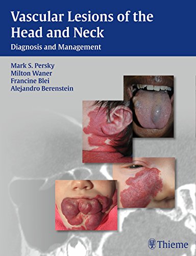 Vascular Lesions of the Head and Neck