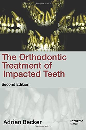 Orthodontic Treatment of Impacted Teeth