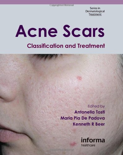 Acne Scars