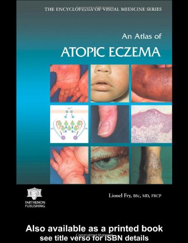 An Atlas of Atopic Eczema