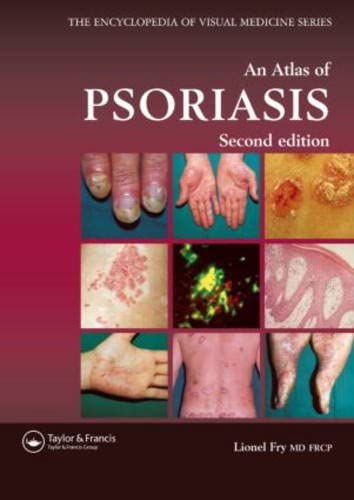 An Atlas of Psoriasis, Second Edition (Encyclopedia of Visual Medicine Series)