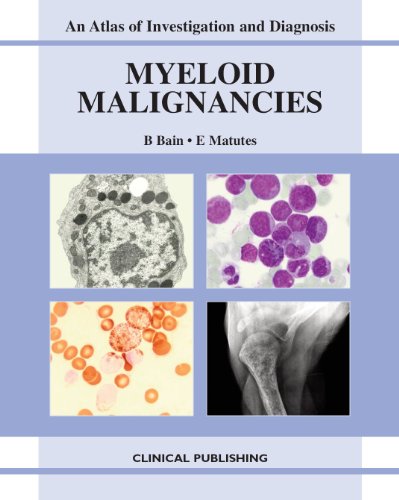 Myeloid Malignancies