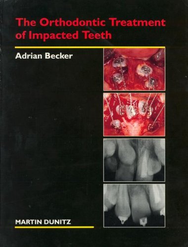 The Orthodontic Treatment of Impacted Teeth