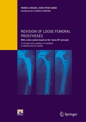 Revision of Loose Femoral Prostheses