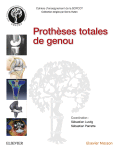 Protheses Totales Du Genou