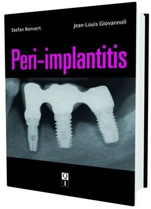 Peri-Implantitis