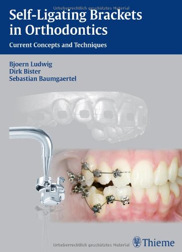 Self-ligating Brackets in Orthodontics