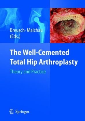 The Wellcemented Total Hip Arthroplasty