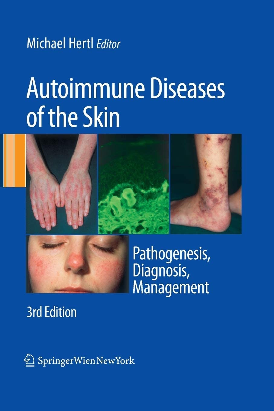 Autoimmune Diseases of the Skin: Pathogenesis, Diagnosis, Management