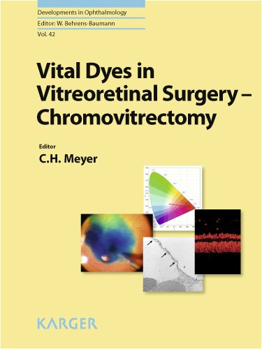 Vital Dyes in Vitreoretinal Surgery Chromovitrectomy