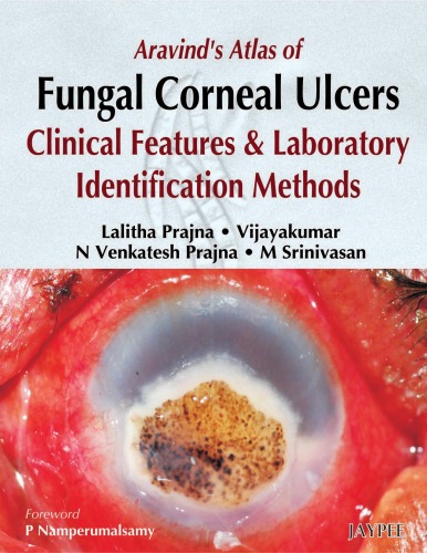 Aravind's Atlas of Fungal Corneal Ulcers